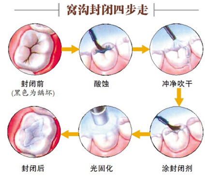 窝沟封闭预防龋齿（图）
