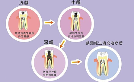 窝沟封闭预防龋齿（图）
